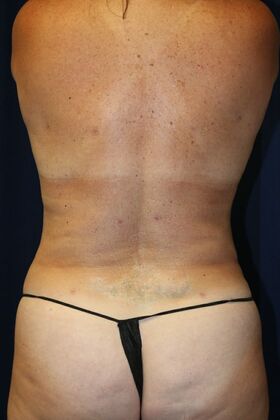 Liposuction & Safe Lipo: Case 50 - After