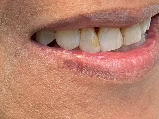 Before and After Gallery Case 13 Bonding - Before