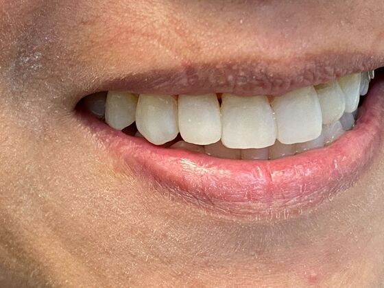 Before and After Gallery Case 13 Bonding - After