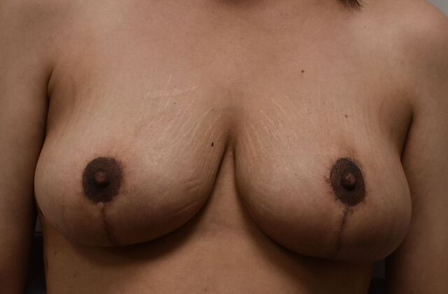 Breast Lift (Mastopexy) Case 139 - After