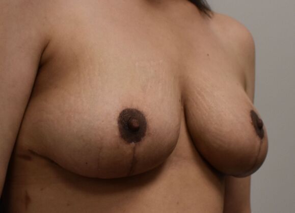 Breast Reduction: Case 135 - After