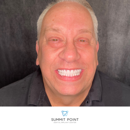 All on 4 Dental Implants: Case 3 - After