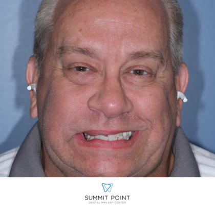 All on 4 Dental Implants: Case 3 - Before