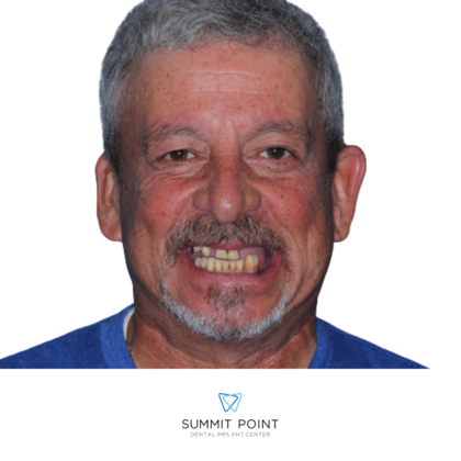 All on 4 Dental Implants Case 4 - Before