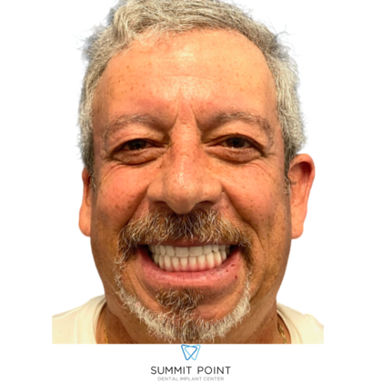 All on 4 Dental Implants Case 4 - After