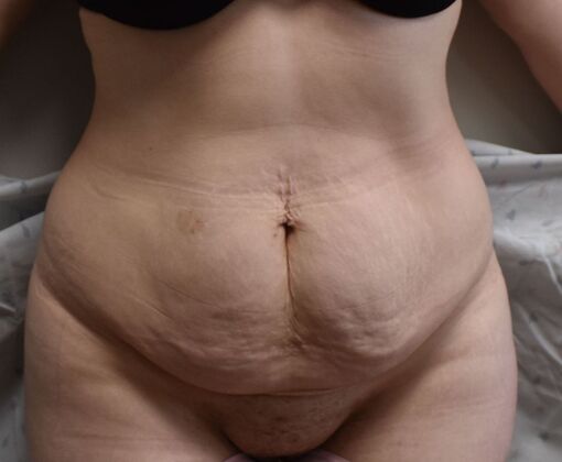 Tummy Tuck (Abdominoplasty): Case 357 - Before