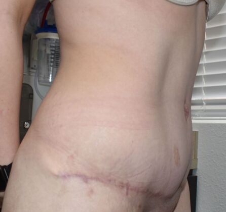 Tummy Tuck (Abdominoplasty): Case 357 - After