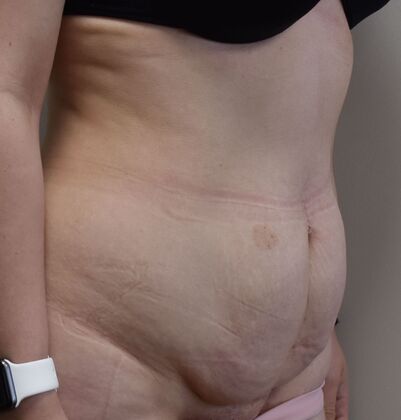 Tummy Tuck (Abdominoplasty): Case 357 - Before