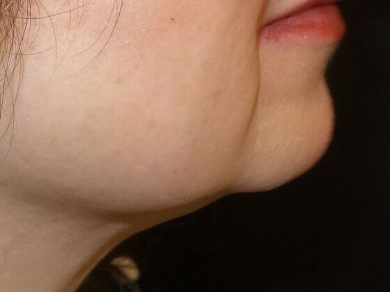 Coolsculpting Case 1 - After