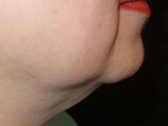 Coolsculpting Case 1 - Before