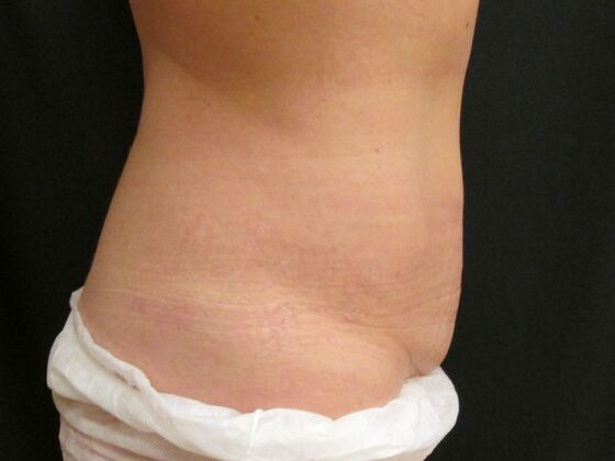 Coolsculpting Case 2 - After