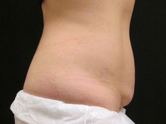 Coolsculpting Case 2 - Before