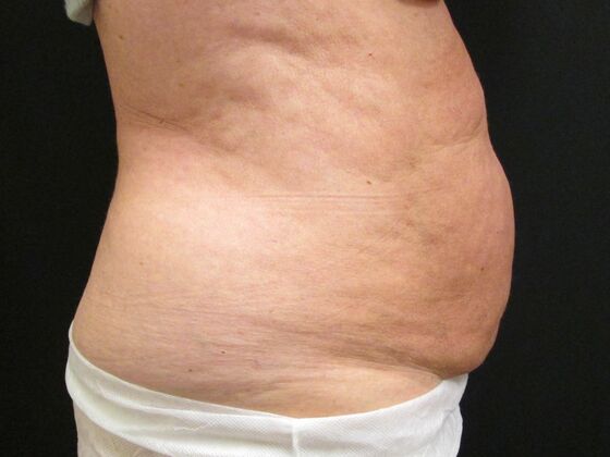 Coolsculpting Case 3 - Before