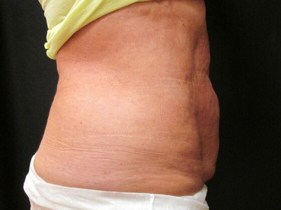 Coolsculpting Case 3 - After