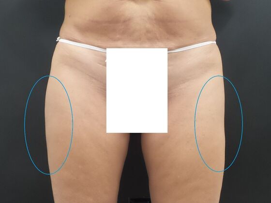 Coolsculpting Case 4 - After