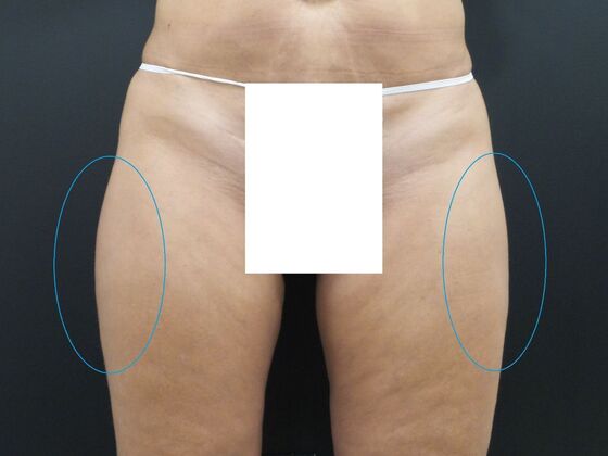 Coolsculpting Case 4 - Before