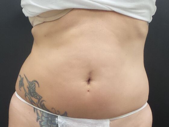 Coolsculpting Case 5 - Before