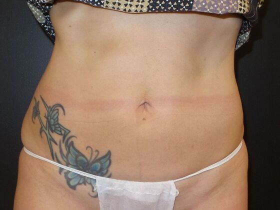 Coolsculpting Case 5 - After
