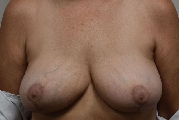 Breast Implant Removal: Case 14 - After
