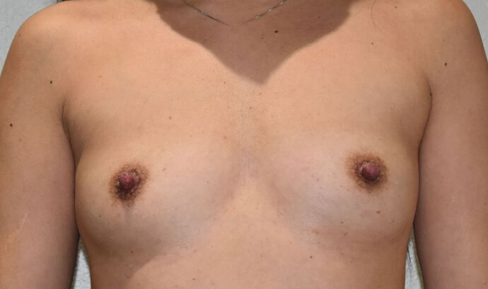 Breast Augmentation Case 699 - Before