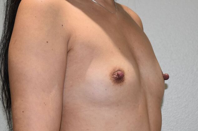 Breast Augmentation: Case 699 - Before
