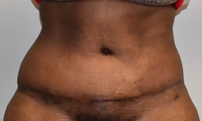 Tummy Tuck (Abdominoplasty): Case 358 - After
