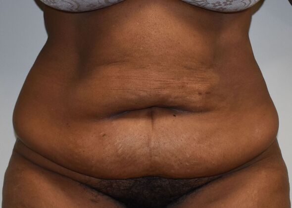 Tummy Tuck (Abdominoplasty): Case 358 - Before