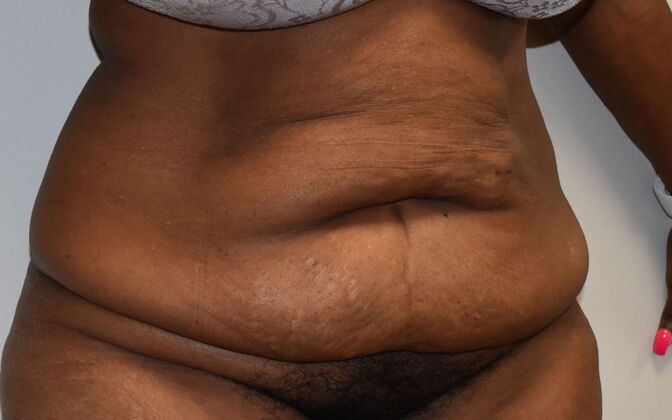 Tummy Tuck (Abdominoplasty): Case 358 - Before