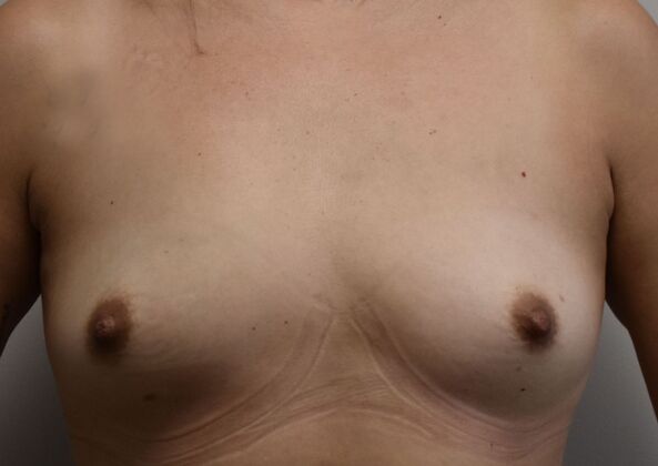 Breast Augmentation Case 701 - Before