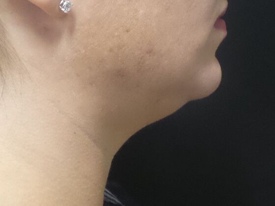 Kybella Case 1 - Before