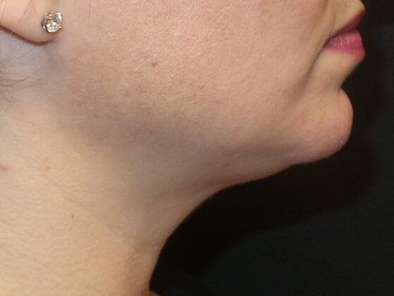 Kybella Case 1 - After