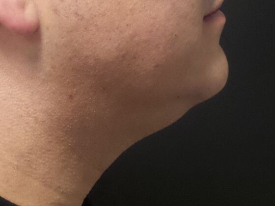 Kybella Case 2 - Before
