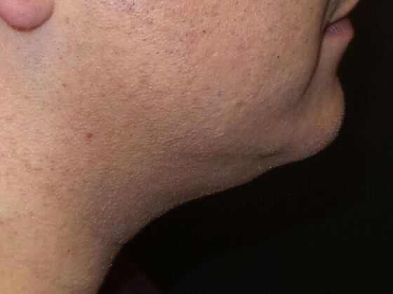 Kybella Case 2 - After