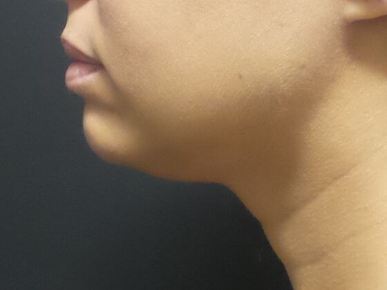 Kybella Case 3 - Before