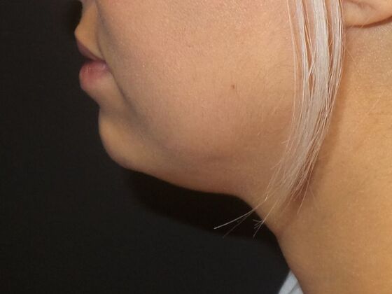 Kybella Case 3 - After
