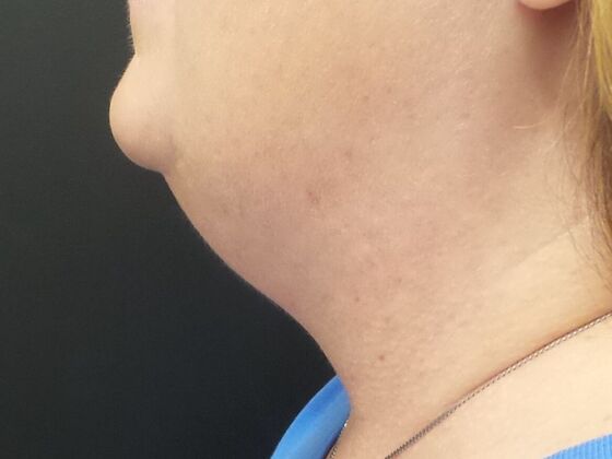 Kybella Case 4 - Before