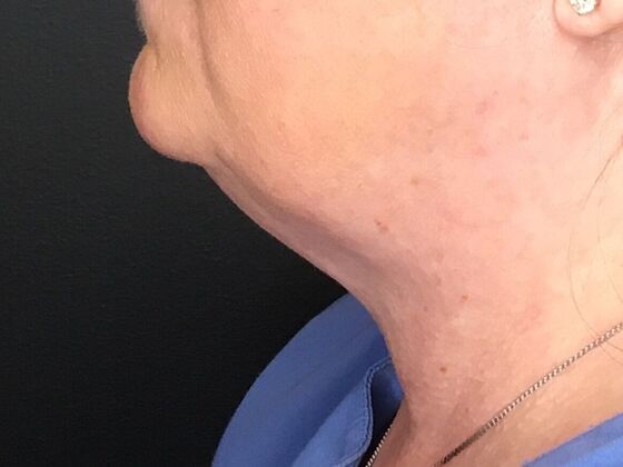 Kybella Case 4 - After