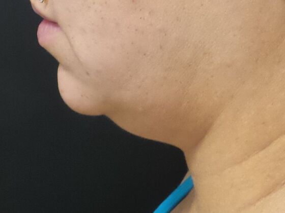Kybella Case 5 - Before