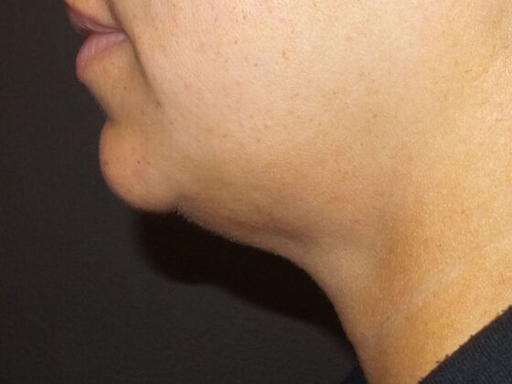 Kybella Case 5 - After