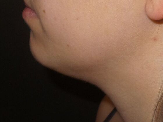 Kybella Case 6 - Before