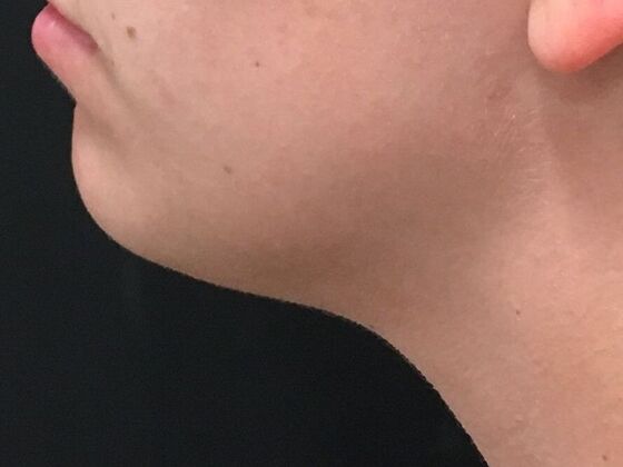 Kybella Case 6 - After