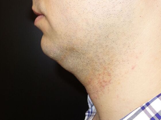 Kybella Case 7 - Before