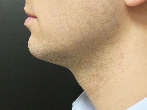 Kybella Case 7 - After