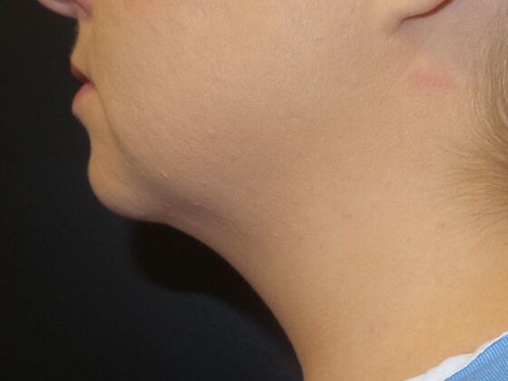 Kybella Case 8 - Before