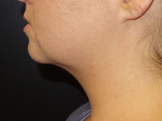 Kybella Case 8 - After