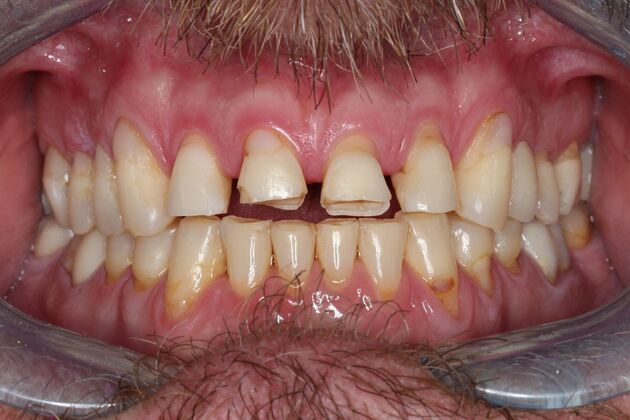 Veneers: Case 26 - Before