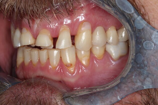 Veneers: Case 26 - After