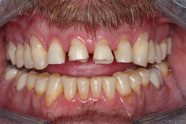 Veneers: Case 26 - After