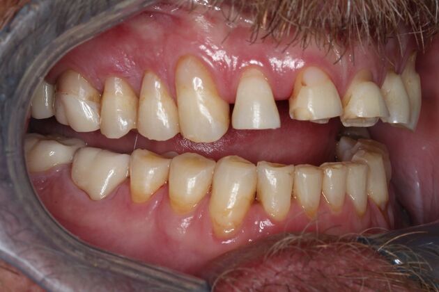 Veneers: Case 26 - Before
