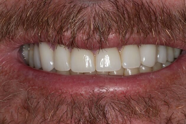 Veneers: Case 26 - Before